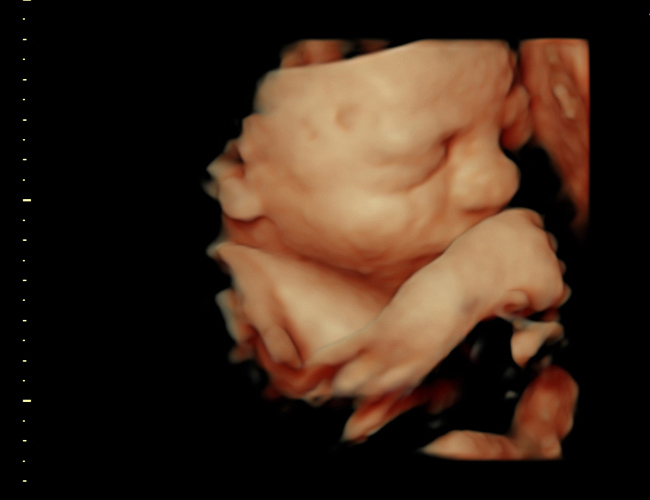 3D ultrasound image at 31 weeks